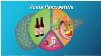 Understanding Acute Pancreatitis